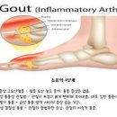 통풍 초기증상 전조증상 손가락 발등 통증 퓨린 음식 이미지