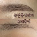 신 기 | 눈썹문신제거 1-3회차 변화 내돈내산 후기 + 재문신