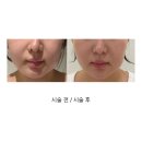 톱헤어라인 | 청담동 피부과 온다리프팅 심부볼 솔직후기 : 붓기 다운타임 부작용 내돈내산