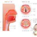 성대결절 원인 성대결절 성대결절 약 좋은음식 이미지