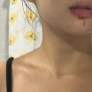 🦷박경준치과 부분 매복 사랑니 발치