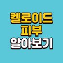아시아방사선 | 켈로이드 흉터? 절대 사라지지 않는다는 건 오해!