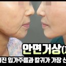 안면거상 재수술 전후 디테일뷰→칼귀교정, 흉터개선, 얼굴피부처짐 개선 효과! 이미지
