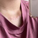 켈로이드 수술하다-!