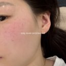 올림 피움 채움 올피채의원 수원점 | [결혼준비 피부과] 망포피부과 올림피움채움 수원점 올피채 더블피코색소 1회차 후기