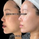 [공지] 슈퍼젝션홈키트 집에서 하는 스킨부스터 4주 집중관리