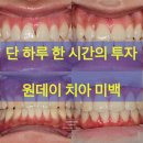 발산 치아 미백 원데이 치아 미백 후기 효과는?