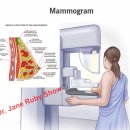 유방 검진 X선 촬영술 암 유발 경고​ 이미지