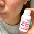 성광 | (사진 후기) 성광 칼라민 로션 여드름 케어 바르는법 꿀팁 경험