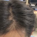 웅선의원 | 내돈내산 탈모치료 후기 (안국 웅선의원 탈모클리닉/ 남성탈모 고민&amp;치료)