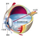 백내장과 녹내장의 증상 모음 이미지