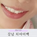 흰치과의원 | 강남 레브치과의원 치아미백 후 일주일 경과 효과