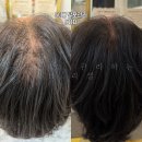 행정중앙2로 | 향남 H.리셀 두피열제로 관리 후기 | 얼굴 홍조까지 잡는 두피 케어