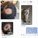 스페이스피부과의원 | 탈모약 고민 전에 꼭 보세요! 당진 피부샵 스페이스뷰티 탈모관리 받은 고객님의 후기
