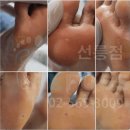 한티 | 한티역 발굳은살 티눈 제거 후기