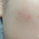 아젤리아 | 아젤리아크림 내돈내산 사용후기 사용방법 , 파는 약국찾는법