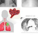 폐에 물이 차는 이유와 폐에 물이차면 생기는 증상 : 폐부종 증상 및 치료 이미지