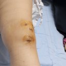 푸디스트(주) 동강병원점 | 슬개골 무릎 뼈 골절 수술-재활-핀제거 후기 성남 정형외과 수술 병원 추천(7개월차 회복기)