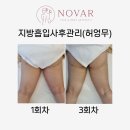 수원 허벅지 지방흡입 사후관리 1-3회차 리얼 후기(허엉무 지흡/샤넬라인)