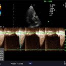 aortic stenosis 이미지