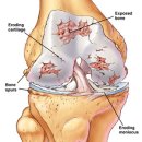 무릎 퇴행성관절염(degenerative arthritis) - 국제물리추나학회 이미지