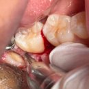 뿌리와새싹치과의원 | [아산 연세원치과]휘어진 사랑니 뿌리, 부러뜨리지 않고 안전하게 뽑는 법