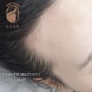 자연공방 | [출산 후 탈모 고민] 극사실주의 헤어라인문신으로 M자 탈모 자연스럽게 커버한 후기 (feat.분당두피공방)