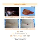 담낭용종수술후. 수술하기 전 사이트 여기저기 다보고 단일공법으로 제일 많이 하셨다고 해서 튼튼병원에서 수술을 하게 되었습니다. 이미지