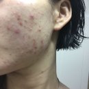 약초와 생활한방 | 여드름자국 피부과 없애는법 한방에 해결 후기