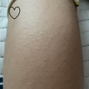 자연닮한의원 | 팔 모공각화증 치료 이것저것 다해봤지만 이거하나로 효과본 후기