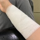 김정문알로에 성동지부 | 서울 화상병원 &lt;상왕십리역 베스티안&gt; 2도 화상 치료 과정 후기, 병원 졸업!