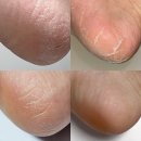 신구약국 | 발바닥 각화형 무좀 발 각질 극복 후기