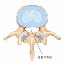 허리가 삐는 요추 염좌 이미지