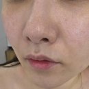동탄 모공관리 받고 피부결이 달라졌어요! 수앤미에스테틱 MTS 후기