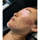 세탁남악점 | <목포.남악피부관리>"또 여드름?" 맨날 속는 광고 말고, 여드름만 싹 잡은 진짜 후기!!