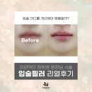 차가미소짓는곳 | 압구정 피부과 이유클리닉 정희영 원장의 입술필러 후기, 필러 전 모습 분석 및 개선 Point