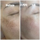 뽀샵 - 창원시 의창구 사림로 118 | 서산 기미·잡티관리 후기✨ 뽀샵 없는 실제 피부 변화 Before & After