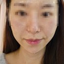 주식회사 청담집 | 풀쎄라PRO 프로 HIFU 팔자주름 탄력 홈케어 구매후기, 효과 있을까