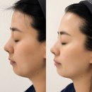 오비오 | 수영구 윤곽관리 잘하는 곳, 수영역 피부관리 오비오에서 엑스업(X-UP) 리프팅 관리 후기