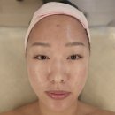 맑은샘약국 | (여드름흉터) 천안 여드름전문 한의원 마지막 율각테라피(총3회) + 부분 새살약침(총3회) 찐후기