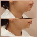 피부앤두피아카데미 | 영통 피부관리 얼굴윤곽 리얼후기, 선에스테스파 수원점 퍼스널윤곽 Before After 솔직 후기