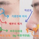 플레저성형외과의원 네이버블로그