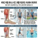 장유누가병원 | 축구하다 종아리를 '퍽!' 돌 맞은 느낌? 테니스 레그(비복근 파열) 재활 및 완치 후기
