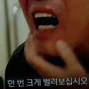 침샘암 방사선 치료 이미지