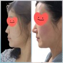 처음처럼성형외과의원 | 코수술후기 내돈내산 코성형비용 첫수술 기증늑 수술전~ 6개월 후기 모음 솔직후기 처음처럼 성형외과