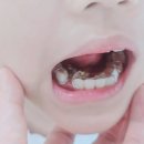 공간기록 | 어린이 치과 교정 후기, 영구치 공간 부족 교정 2개월 기록