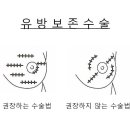 유방보존수술의 그림 Breast cancer Lumpectomy 이미지