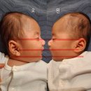 삼성의료기 | 두개골조기유합증(우측관상봉합,95일아기:3개월)신연기 수술후기(서울아산병원 소아신경외과)