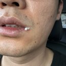 오천성모의원 | 구내염? 헤르페스 1형 증상 및 병원과 치료후기