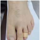 좋은세상의원 | 구파발역 365이화웃는세상의원에서 내성발톱과 발톱무좀 타파 후기.